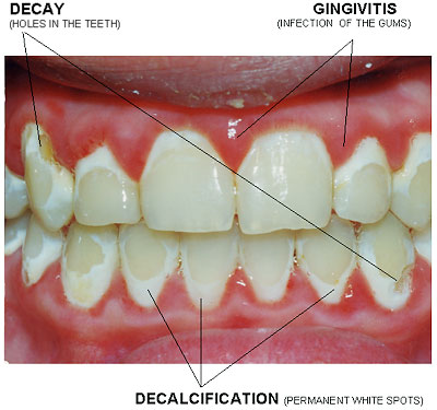 braces brush clean brushing orthodontic don teeth flossing orthodontics often patient gingivitis cleaning bother patients treatment max forget during too